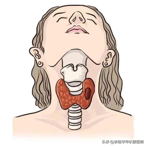 甲状腺结节血流信号怎么看,甲状腺结节报告怎么看