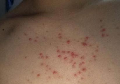 后背长痘的原因和改善方法,后背满背的痘是什么原因