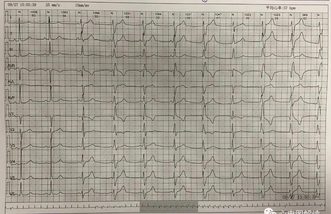 三度房室传导阻滞交界性逸搏,加速的室性逸搏心律的心电图表现