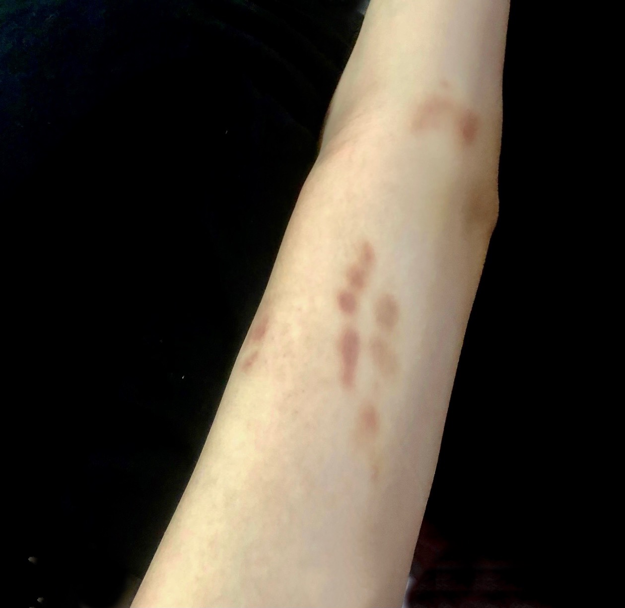 麦迪森健康：身上不痛不痒却总是莫名淤青？这些情况要注意