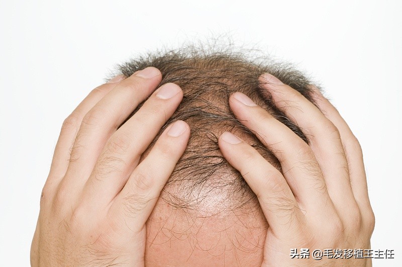 头痒出油头屑多怎么办,头皮特别痒头屑多出油快还爱长痘