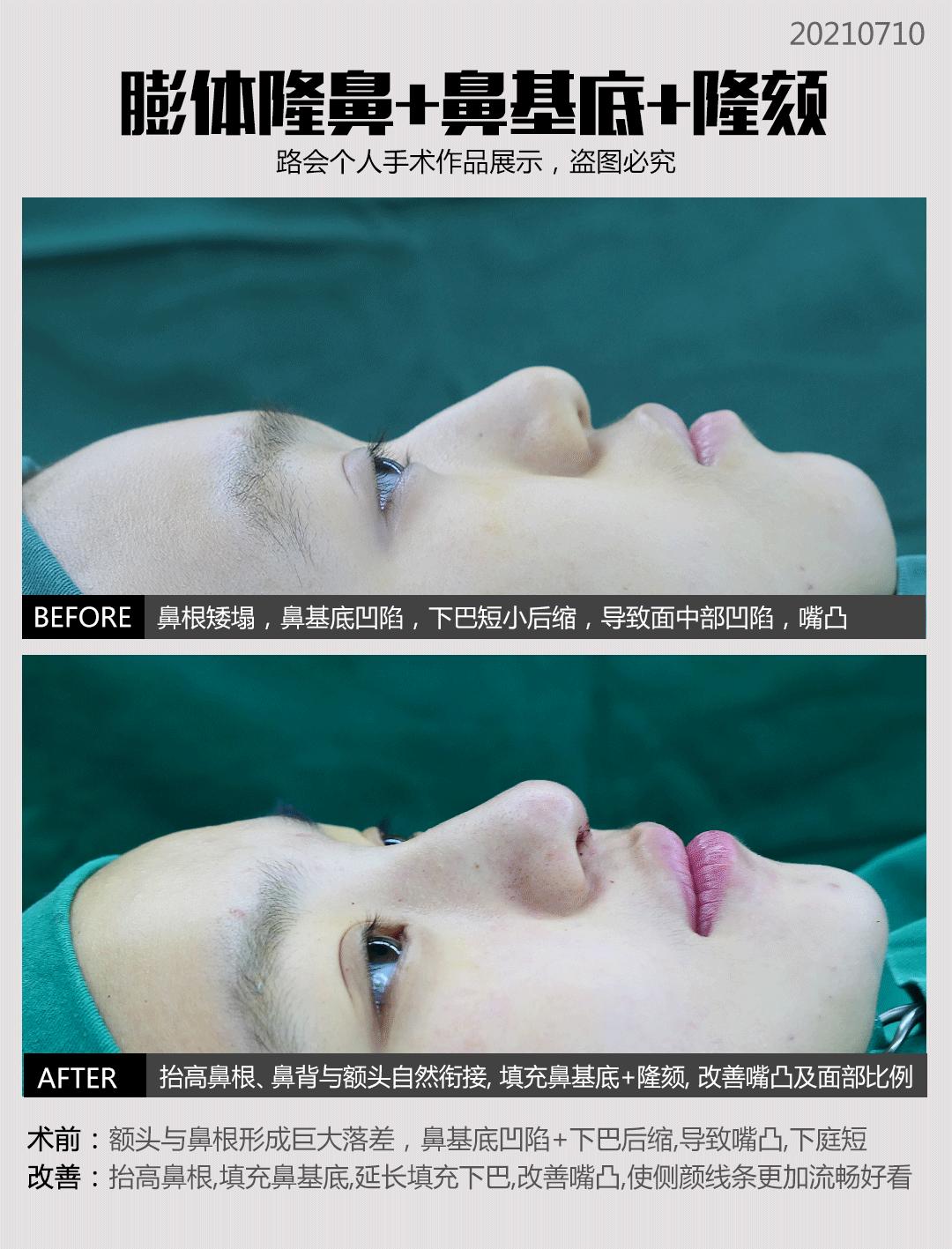 线雕隆鼻和软骨隆鼻哪个好,线雕隆鼻跟假体隆鼻哪个好看