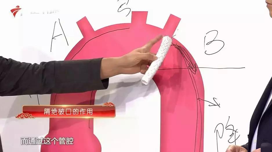 主动脉夹层手术后会猝死吗,主动脉夹层破裂猝死有救吗