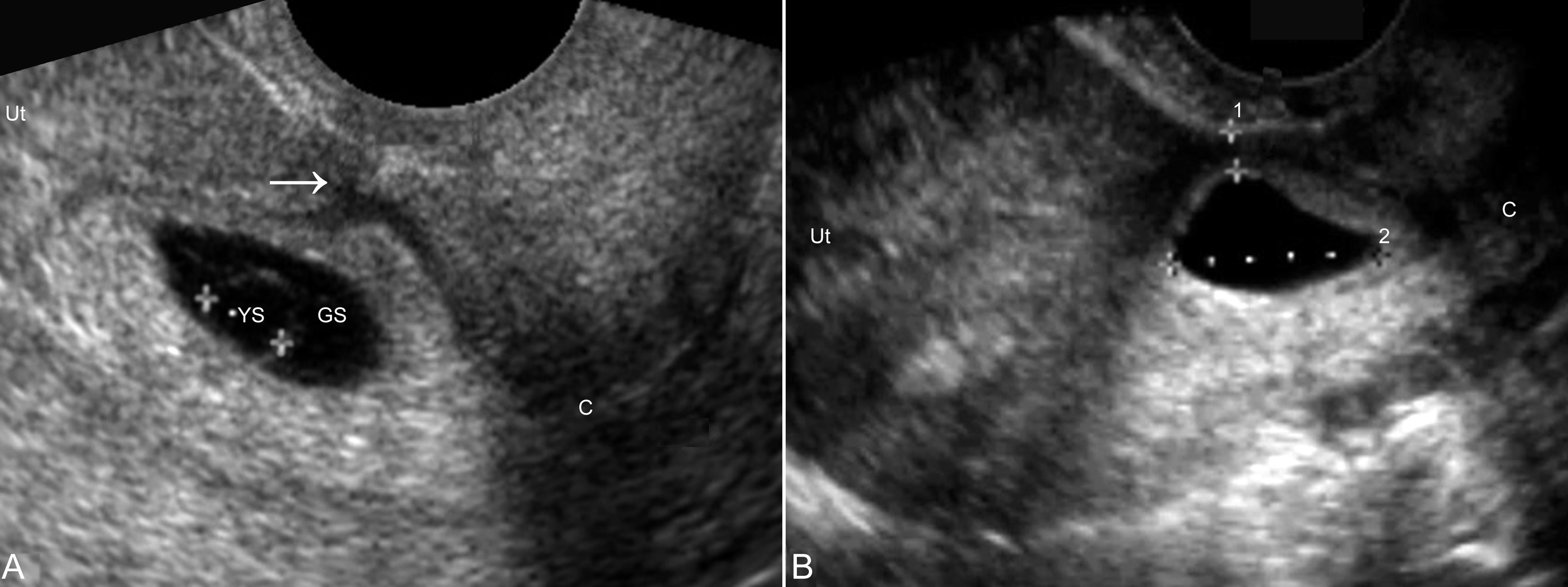 瘢痕妊娠超声经腹壁检查怎么测量,剖宫产子宫瘢痕超声检查