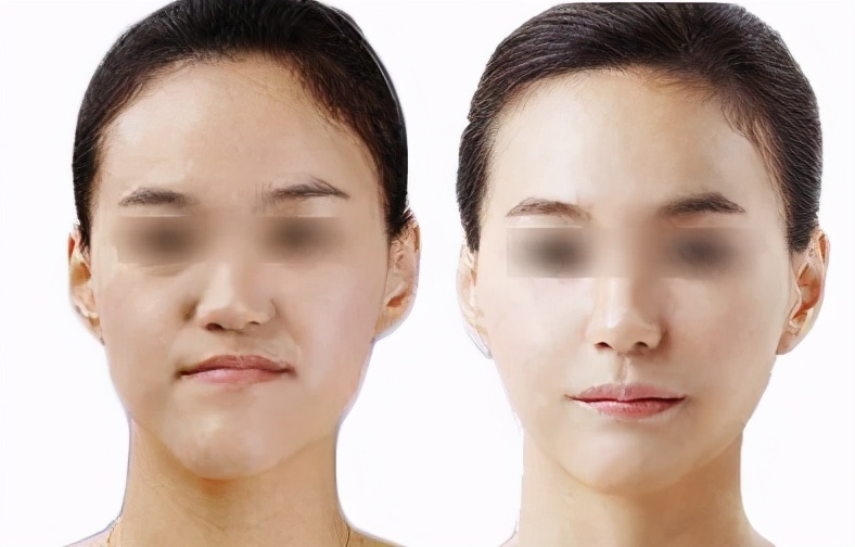 长期单边咀嚼后大小脸怎么恢复,单侧咀嚼大小脸可以恢复吗