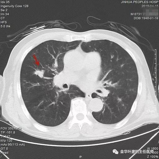 能不能手术,极重度混合性通气功能障碍能治吗