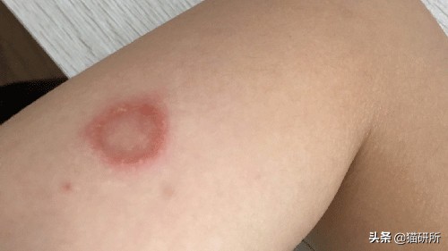 你们的猫咪猫癣怎么治好的,亲身经历的猫癣怎么治