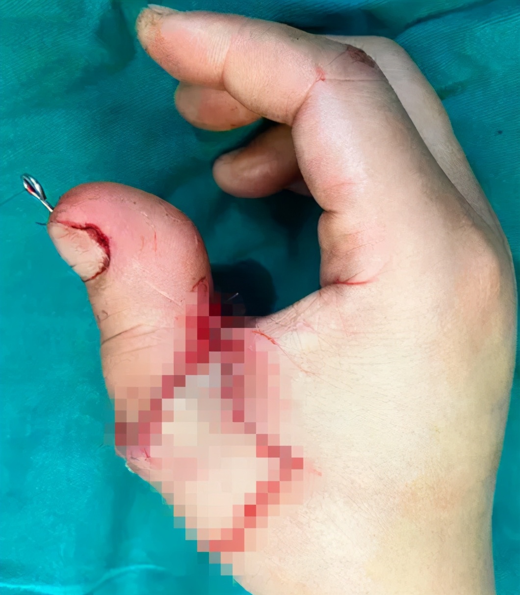 大拇指断了为什么只能用脚趾接,大拇指断了用脚拇指代替