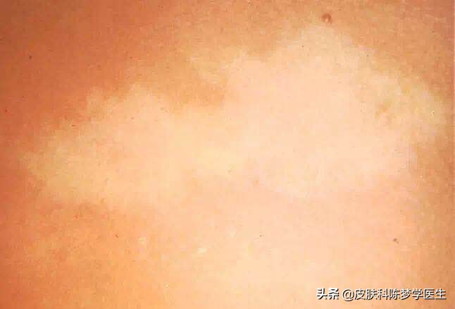 如何鉴别皮肤白斑是否是白癜风,皮肤长白斑用什么药膏
