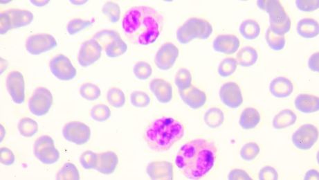 吃辣条引起的过敏性紫癜能恢复吗,吃辣得过敏性紫癜能自愈吗