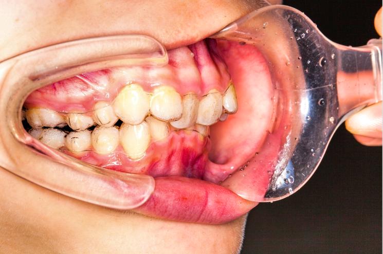 没有牙齿的牙龈肿痛怎么办,牙龈肿痛牙齿松动牙龈出血
