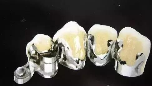 如何挑选烤瓷牙材料,怎样选择适合你的烤瓷牙