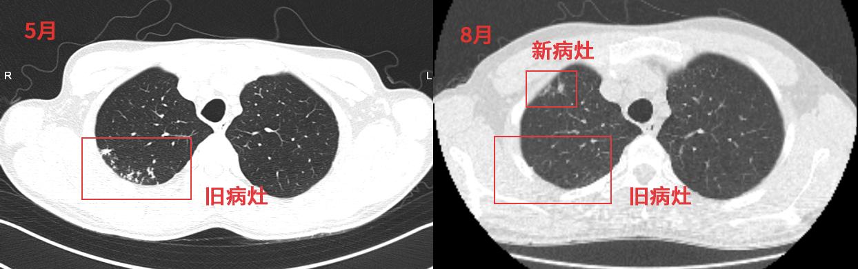 结核治疗后好转是继发还是原发,结核病痊愈后会留下病灶吗