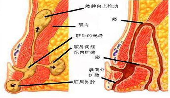 肛瘘手术比生孩子还痛吗,做完肛瘘手术疼痛怎么解决