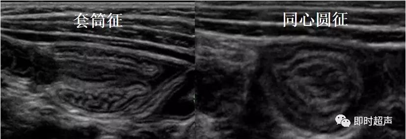 小儿消化道急症超声