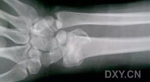 特殊骨折类型,特殊骨折体征