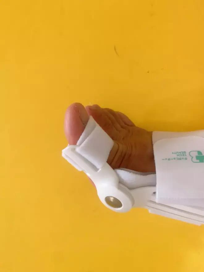 大脚趾拇指外翻矫正用多久,大脚拇指外翻导致第二脚趾弯曲