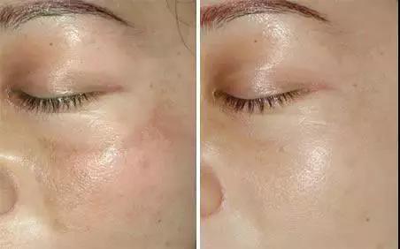 如何区分脸上色斑类型图片,如何辨别面部的各种斑