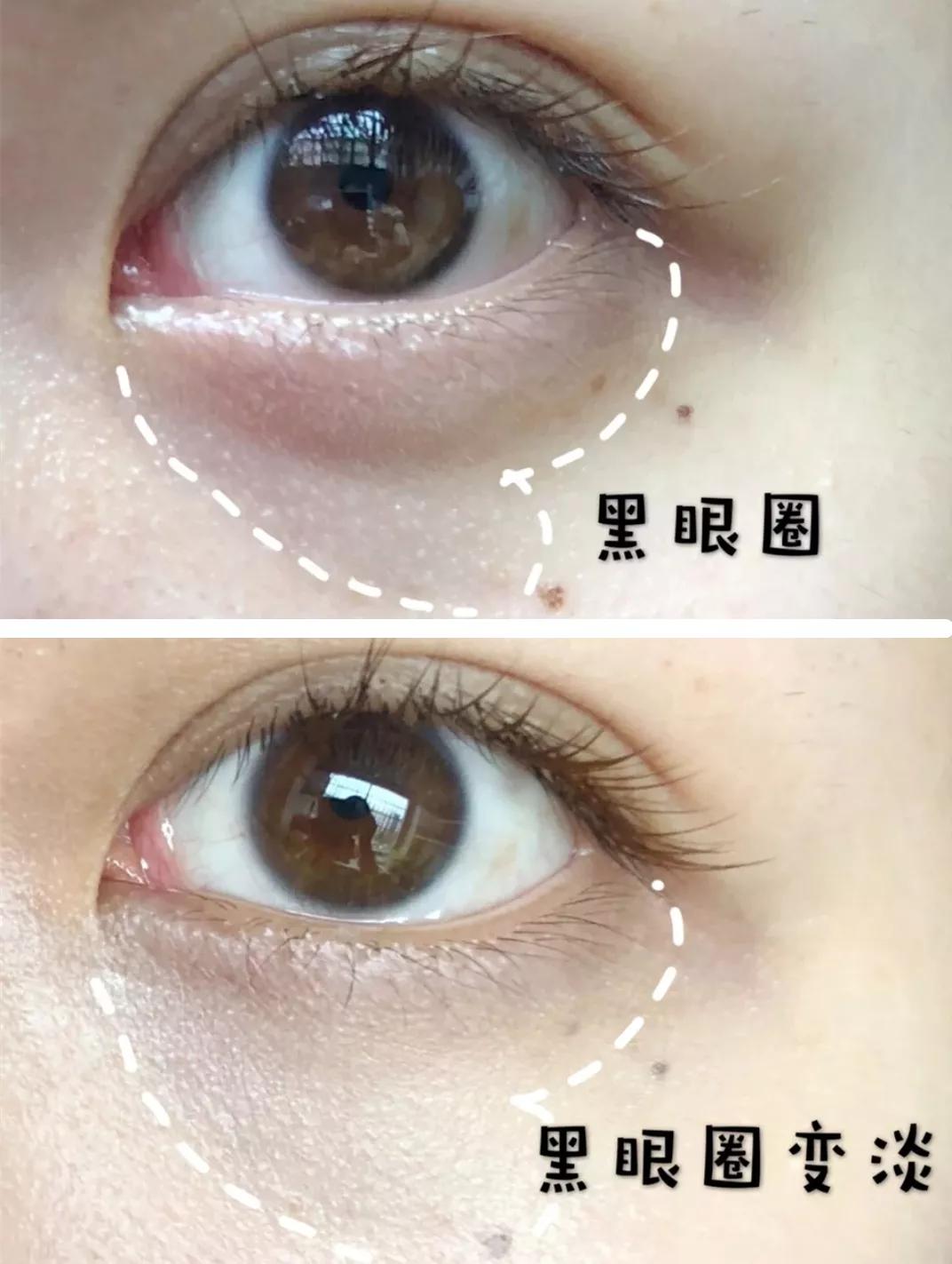 别再用针挑！用米澳拉，脂肪粒自己“掉”下来，效果胜过医美激光