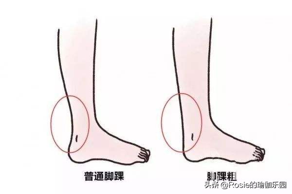 双腿粗最有效方法,腿粗如何凸显脚踝