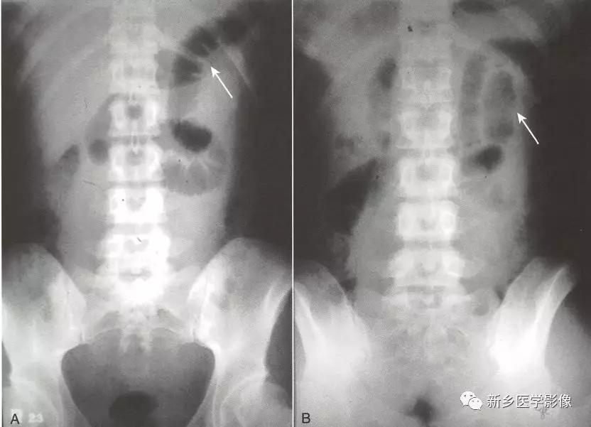 辨识肠梗阻,肠梗阻死亡前兆
