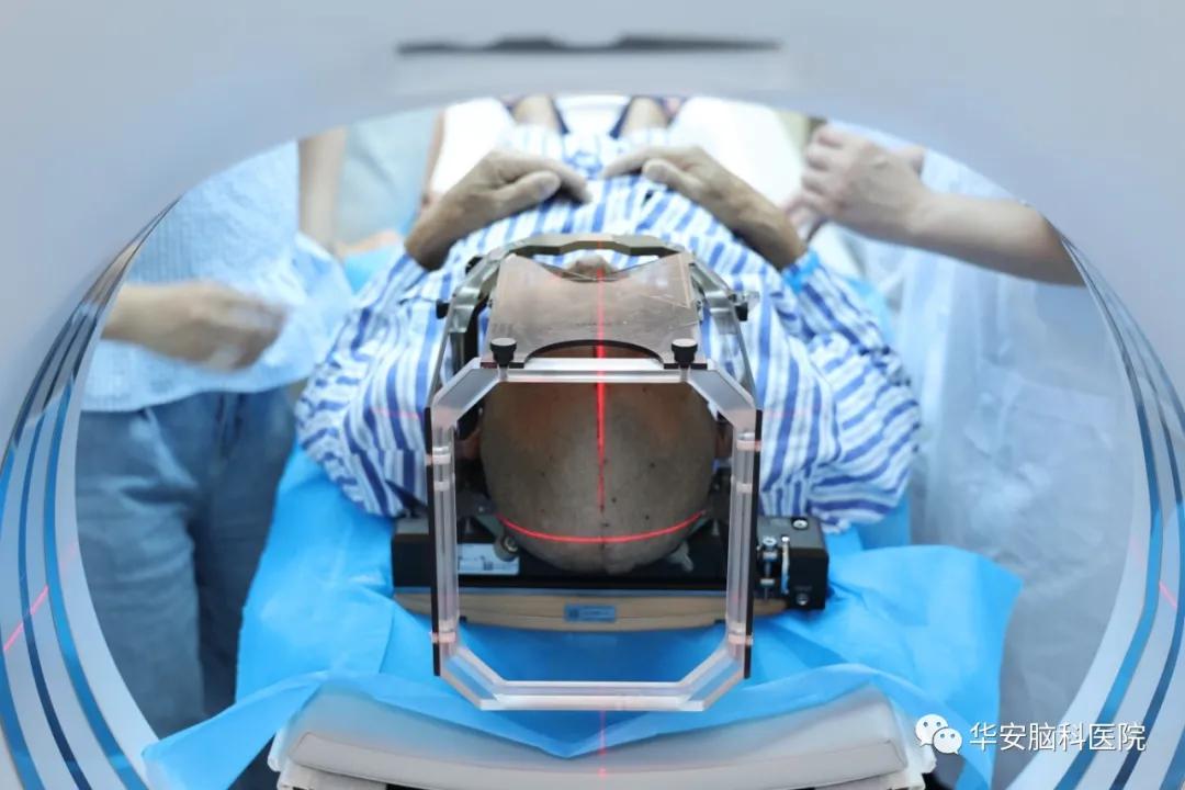 梅杰综合征dbs手术需要开颅吗,梅杰dbs手术住院需要几天