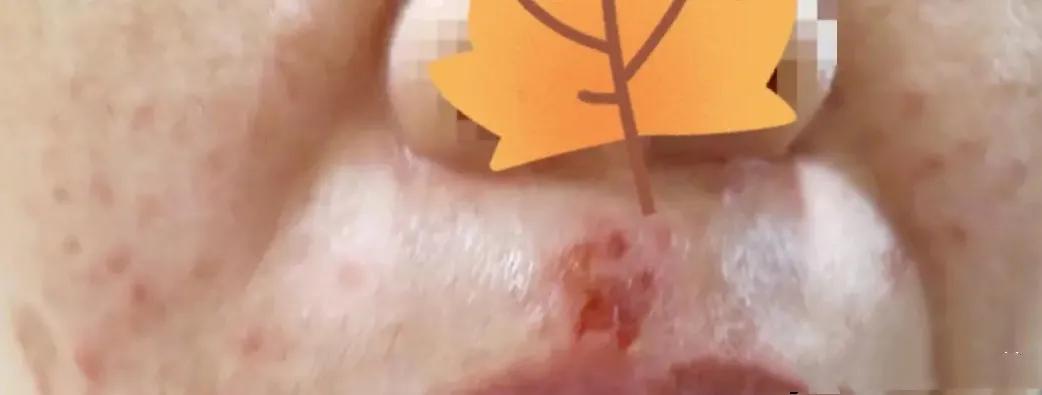 嘴唇反复起泡发炎是什么情况,嘴唇红肿起泡有灼烧感周围一圈红