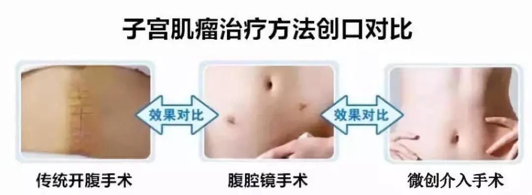 专家讲治疗子宫肌瘤的方法,微创介入子宫肌瘤栓塞术