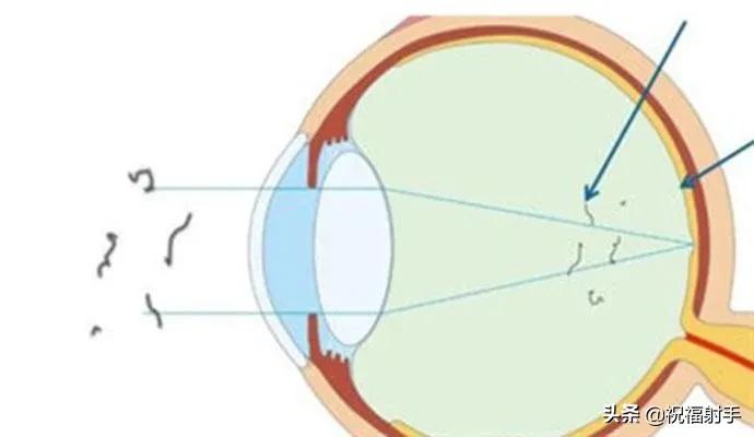 专家谈老年飞蚊症的治疗,飞蚊症老年人
