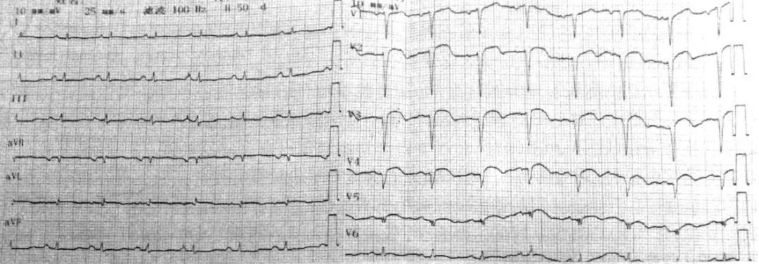 急性心梗合并心源性休克治疗原则,心梗引起心律失常