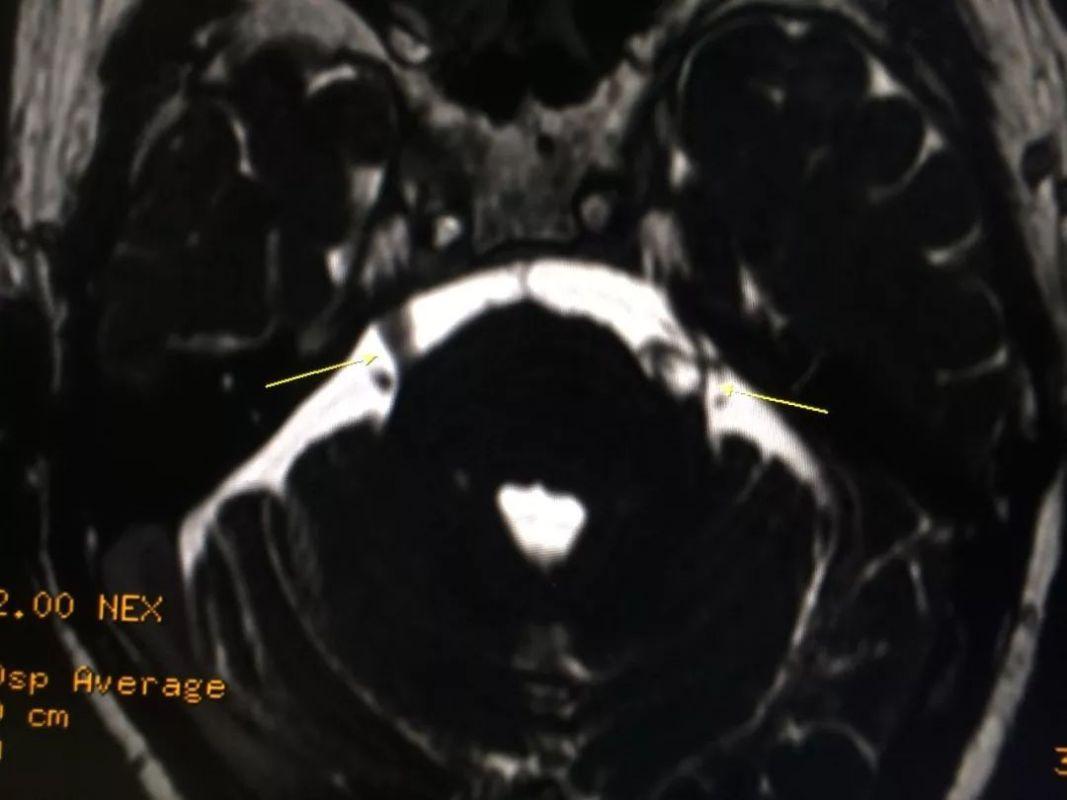 泌乳素瘤不来月经子宫会萎缩吗,绝经后泌乳素瘤用治疗吗
