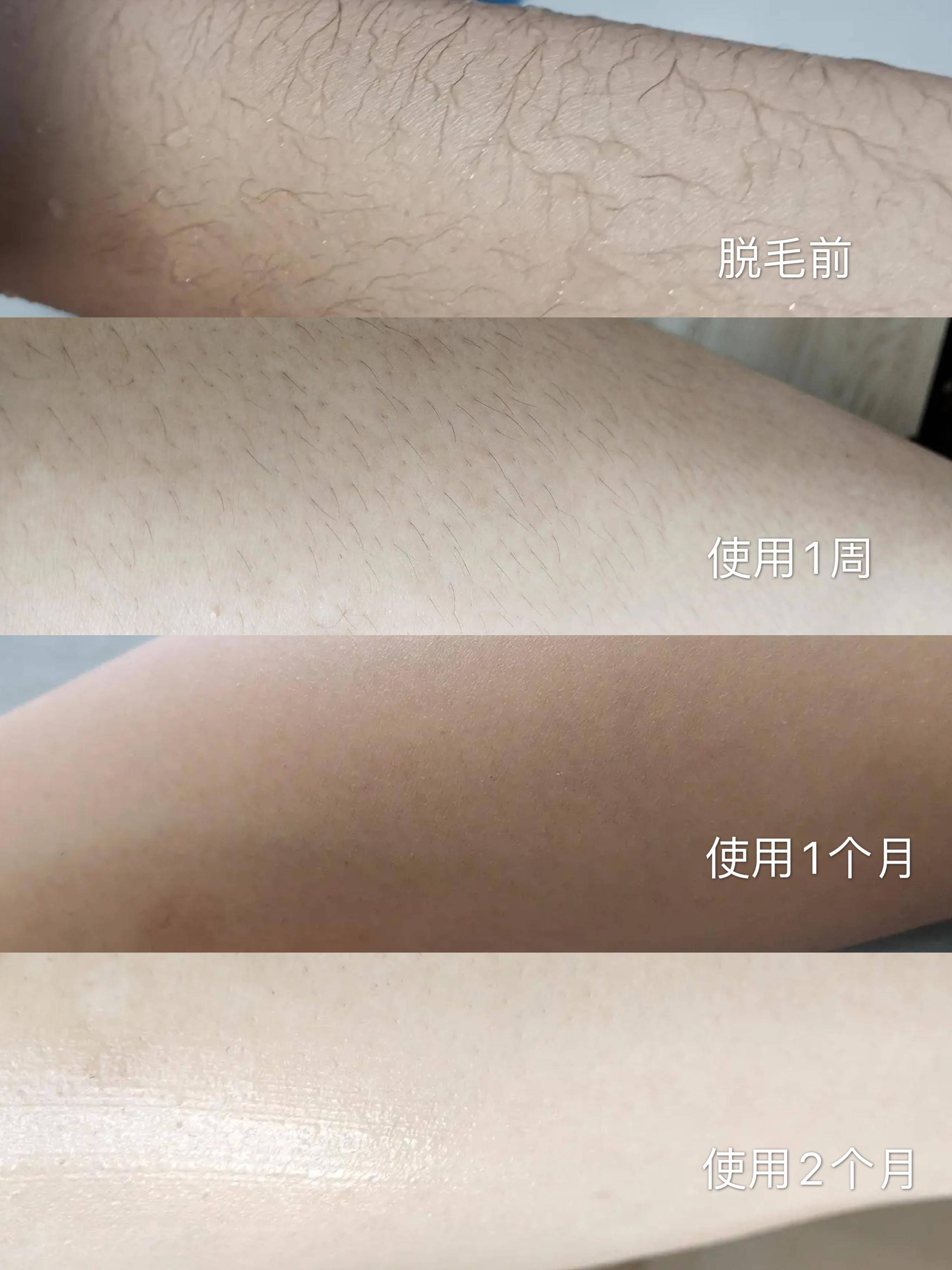 脱毛仪一年后用户测评,脱毛仪的真实使用感受