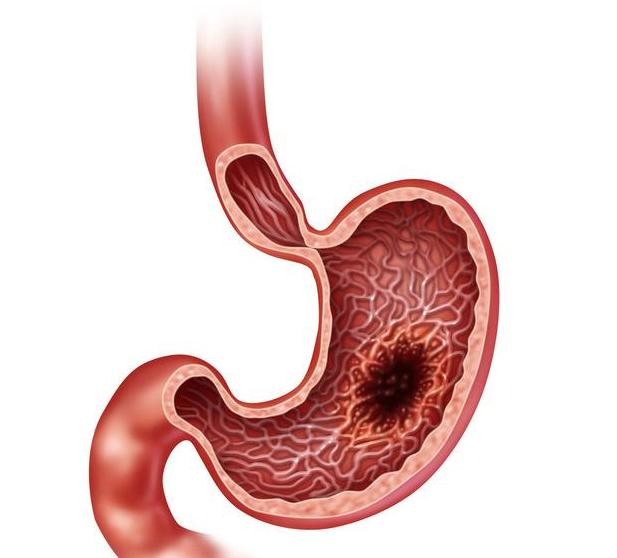 胃溃疡用什么药治疗见效快最彻底,胃糜烂和胃溃疡吃什么药比较有效