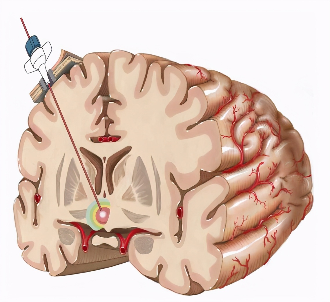 癫痫能治愈吗？激光间质热疗（LITT）如何方寸之间消融病灶？