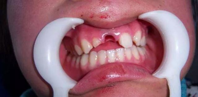 宝宝牙齿磕掉,儿童牙齿磕松了能自己好吗