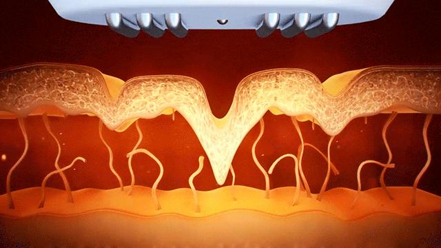 美容射频仪的坑,美容仪的坑你踩过几个