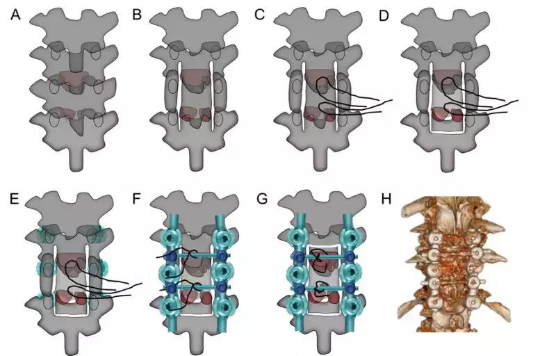 胸椎黄韧带骨化的治疗方法,胸椎黄韧带骨化症手术效果如何