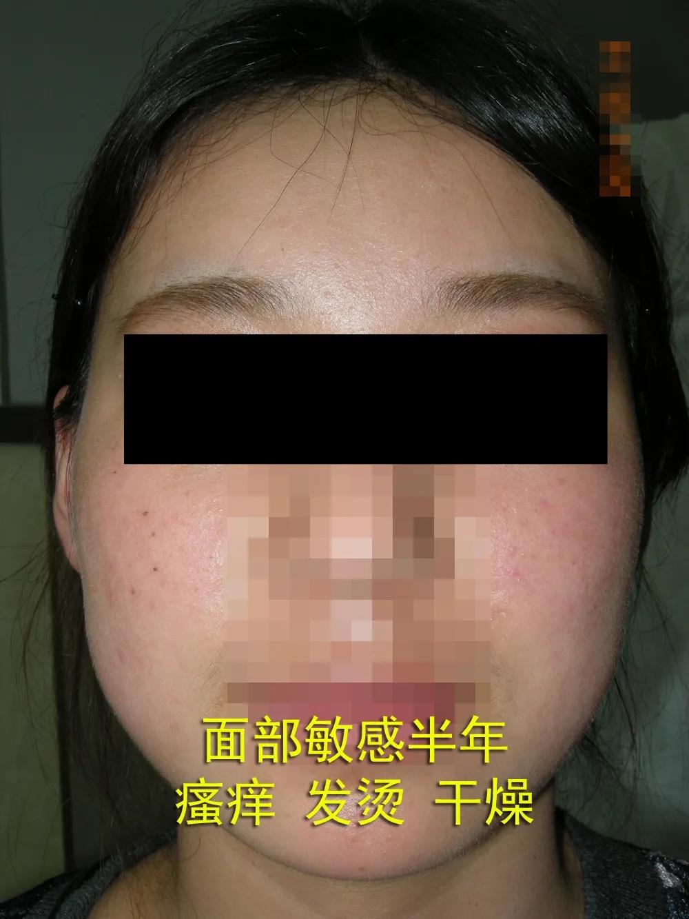 激素依赖性皮炎可以用什么护肤品,护肤要重视肌肤的免疫力