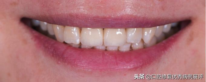 展评优秀病例赏析|Asc全瓷角度基台一体冠进行种植前牙美学修复