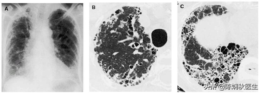 肺部纤维灶会是肺癌吗,肺部纤维灶意味着有小结节吗