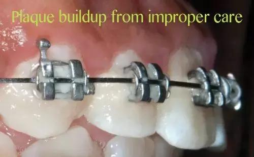 牙套只戴上面的行吗,刚戴牙套就不需要去医院吗