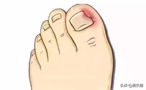 夏天艾灸和冬天艾灸,又到了艾灸的季节