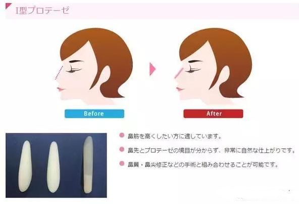 日本整容真的很好吗,日本整容vs韩国整容图片对比