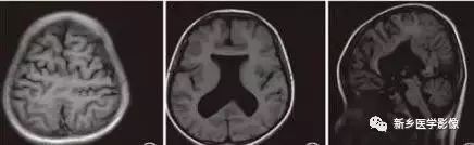 什么引起成人脑室扩大,哪些病可以导致左侧脑室增宽