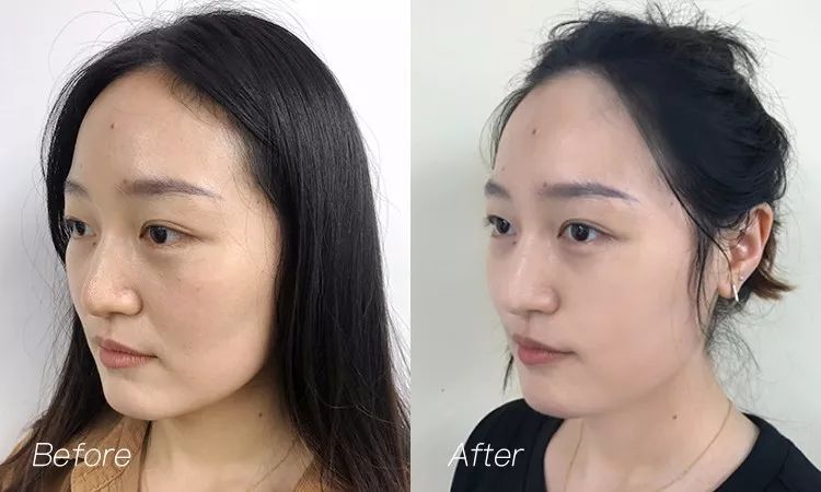 长黑头VS不长黑头差距这么大?精致女孩如何绕过黑头这道坎?