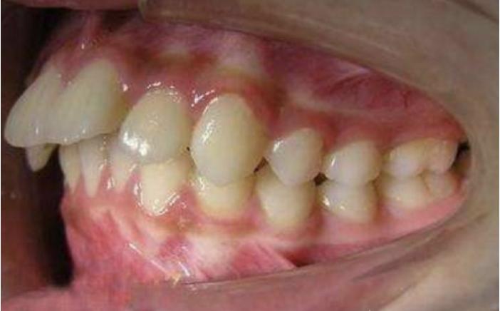 骨性地包天不做正颌手术最好方法,骨性地包天不做手术可矫正吗