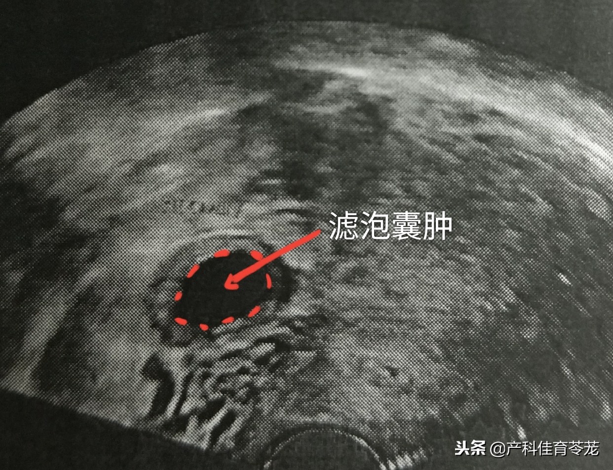 卵巢囊肿做了肿瘤标志物显示正常,卵巢囊肿内见密集光点正常吗