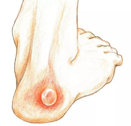 怎么预防跑步起水泡,一到夏天跑步脚就起泡怎么办