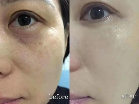 美容针美容的误区,为美而整容最后付出的代价