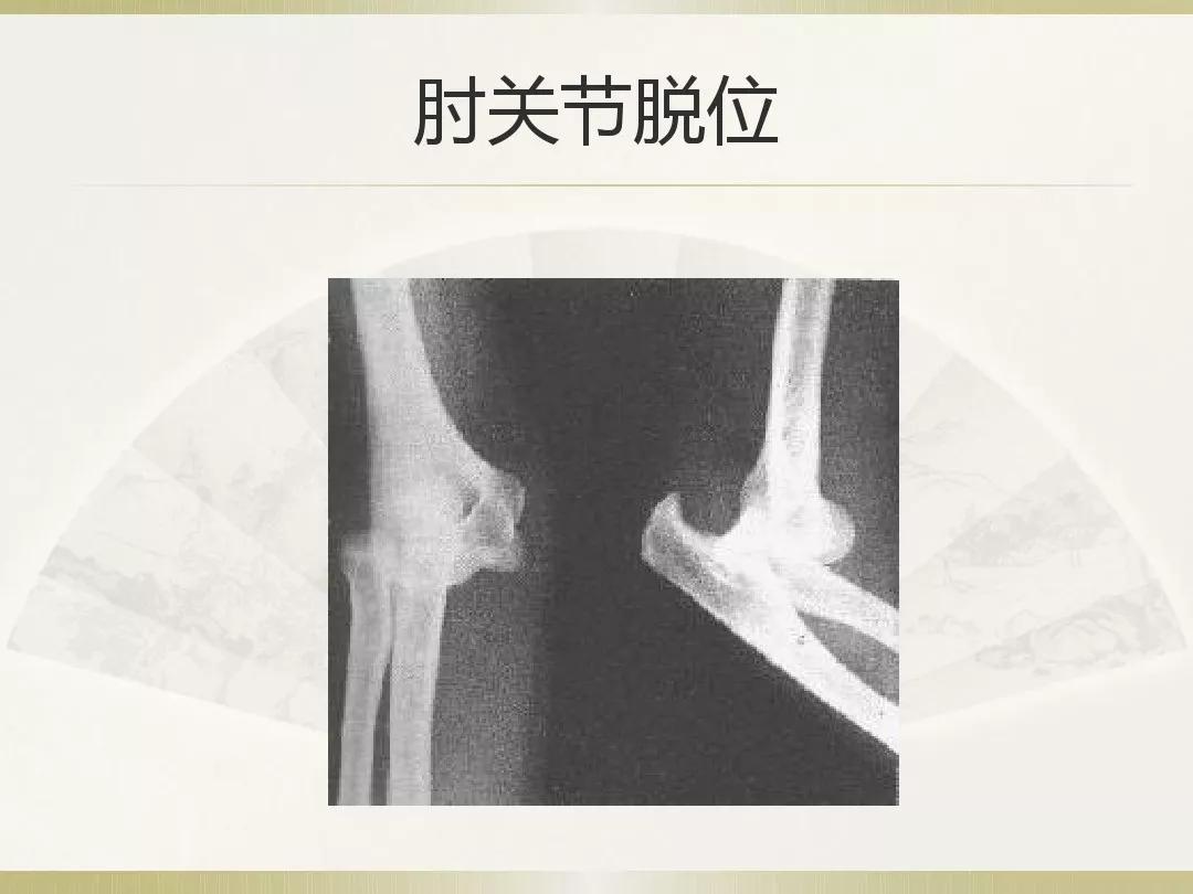 骨科x光片读片技巧,放射科骨科读片教程